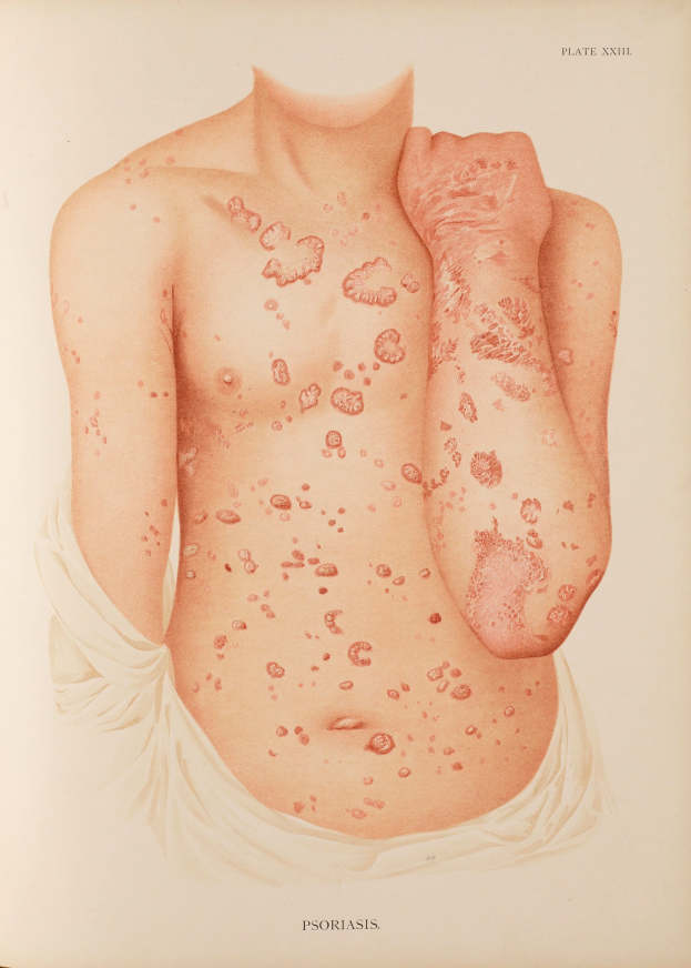Buchumschlag mit einer Illustration eines Mannes mit rotem Ausschlag auf der Brust, der wahrscheinlich Psoriasis darstellt, und Textinformationen zum Thema.
